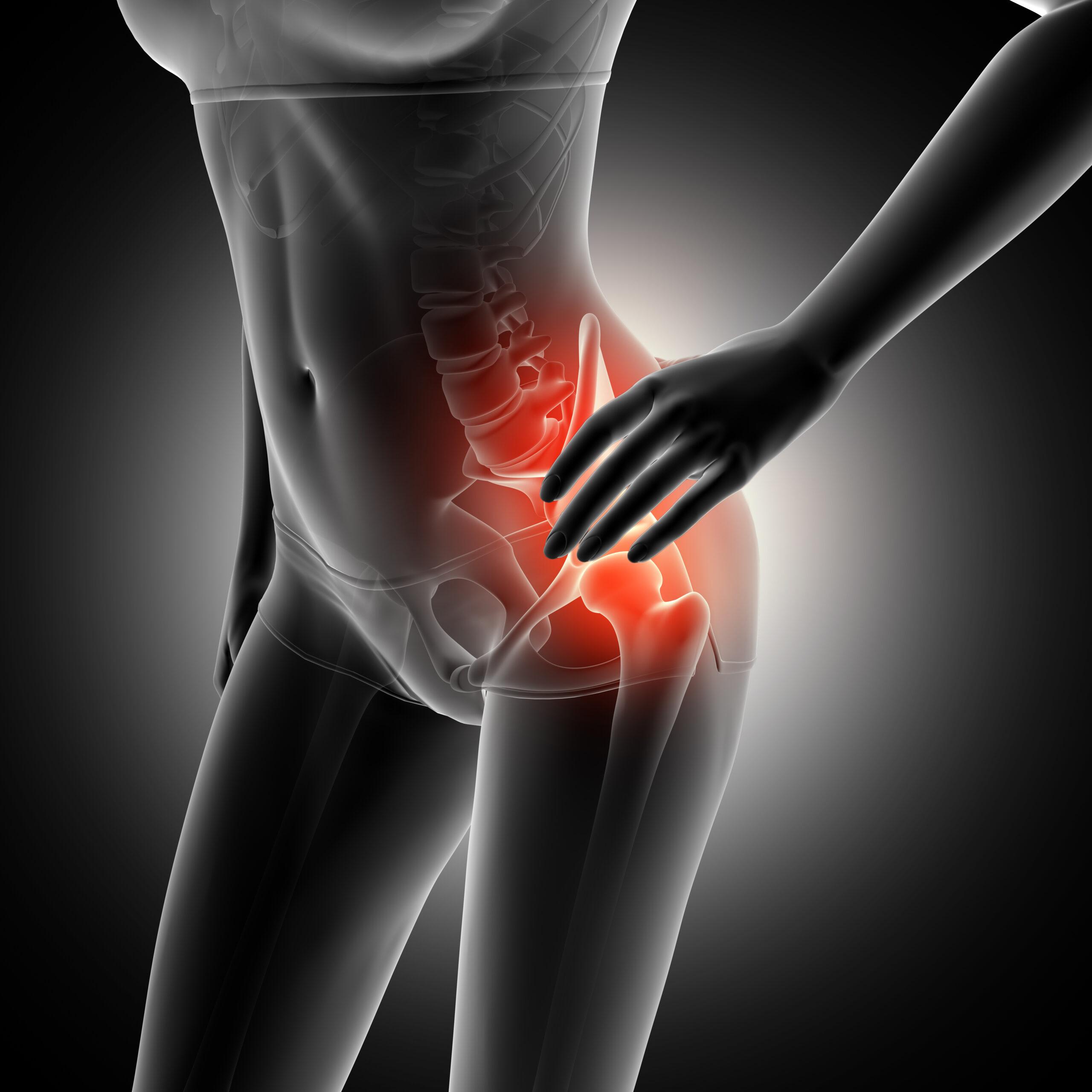 Sciatica or Sciatic Nerve Pain