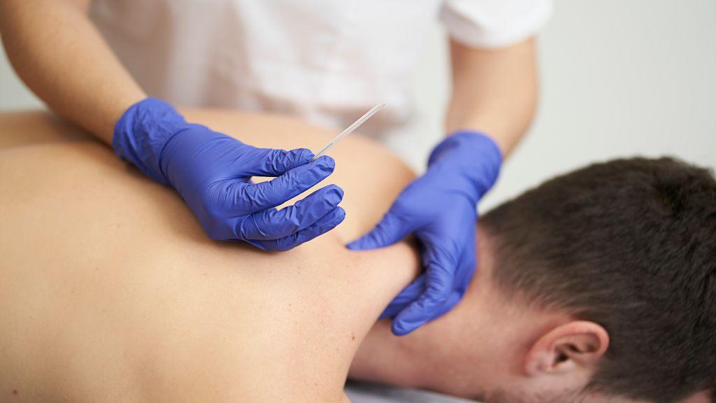 Dry Needling Treatment